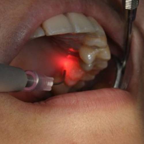 Dental Laser Machine in Delhi